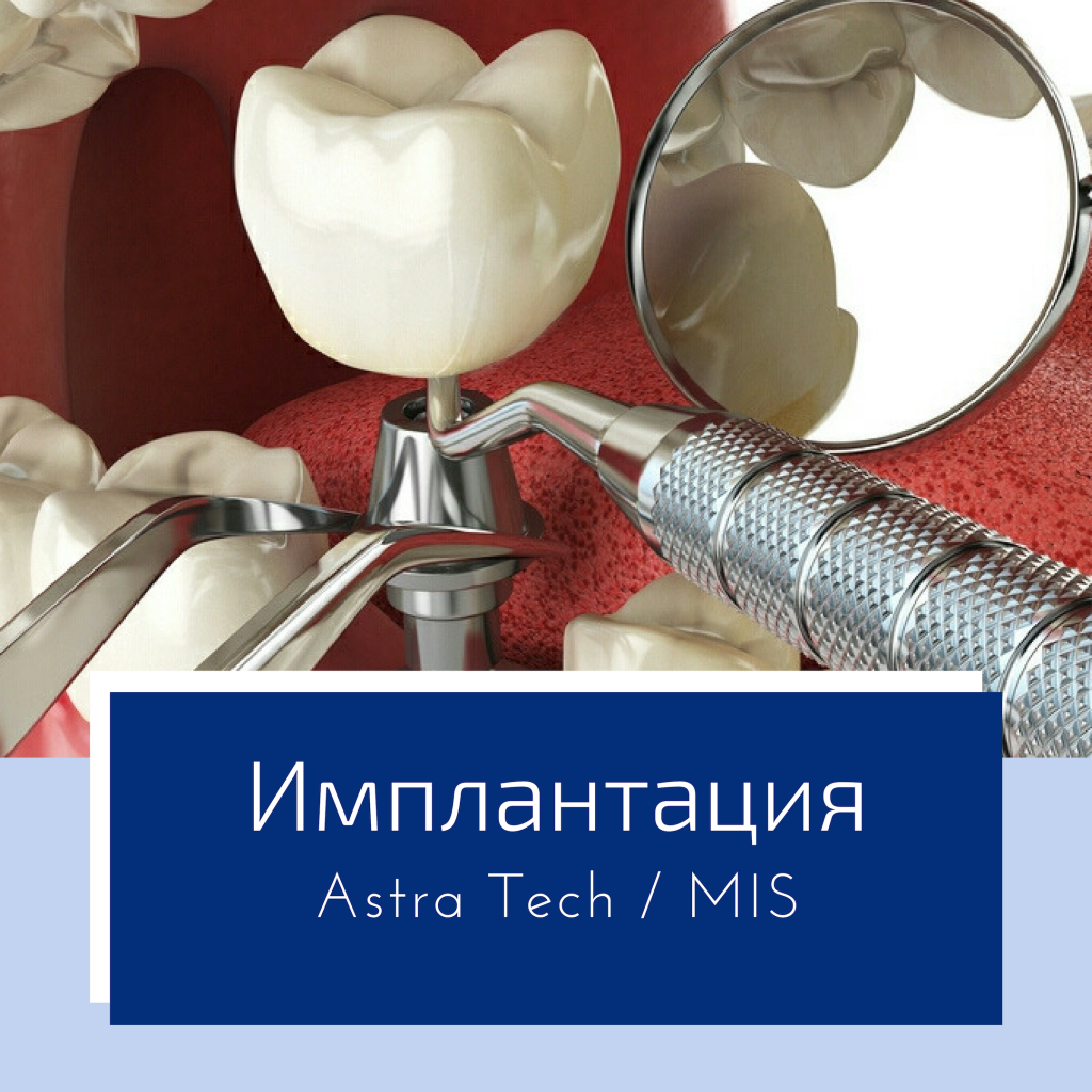 Имплантация Астра Тек Имплантация.png